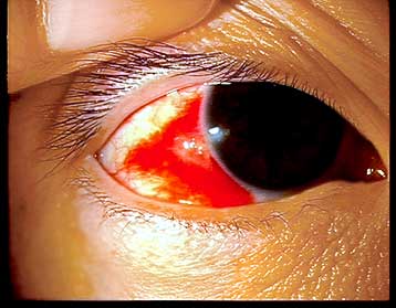 目 の 充血 原因