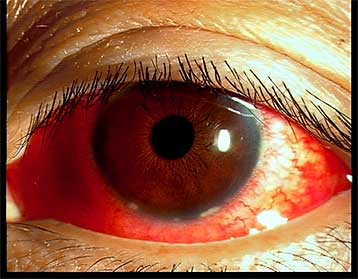 目 の 充血 原因