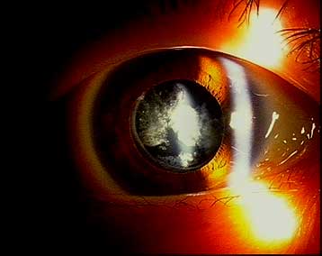 後発白内障 写真